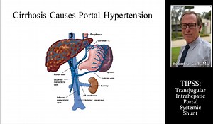 TIPS手术过程详解-2