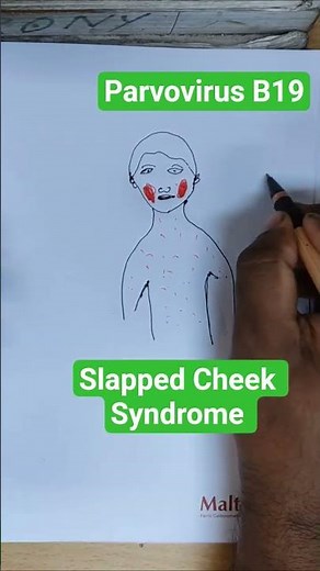 Slapped Cheek Syndrome.