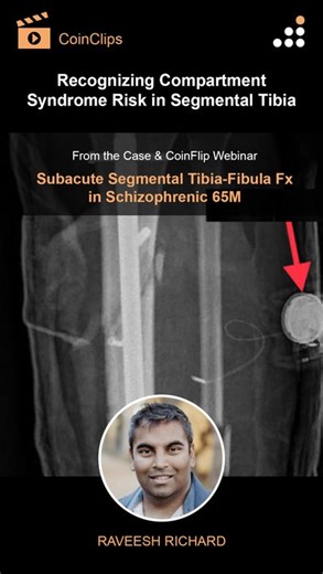 Orthobullets on Instagram: "Here is a clip from our latest episode of CoinFlips & Controversies, “Subacute Segmental Tibia-Fibula Fx in Schizophrenic 65M.” Watch Dr. Richard discuss “Recognizing Compartment Syndrome Risk in Segmental Tibia." Click the Link in Bio to learn more and watch their full webinar on Orthobullets."
