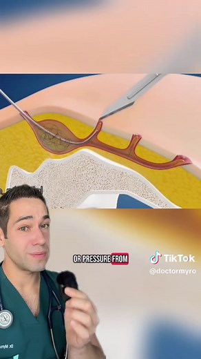 Understanding Cysts: Doctor Explains Pilonidal Cyst