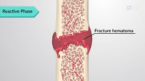 Video: Fractures: Bone Repair