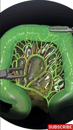 Revolutionizing Colon Surgery with Fluorescent Dye