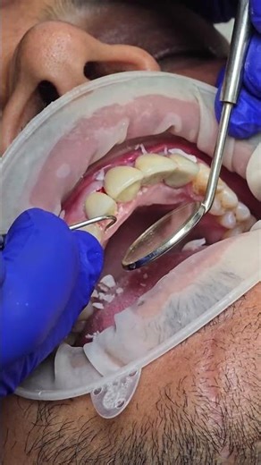 Front Teeth Implant 😍 | Natural Smile Back