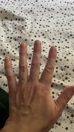 I Ignored My Hand Pain, Then It Turned Into This