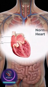 82K views · 1.2K reactions | Atrial Fibrillation: Disrupted Electrical Signals and Irregular Heart Rhythm. #AFibExplained #Cardiology #HeartRhythm #MedicalEducation #AtrialFibrillation | Medical Animation Media | Facebook