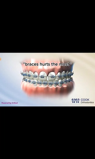 The Downsides of Expanders: Why Patients Prefer Braces