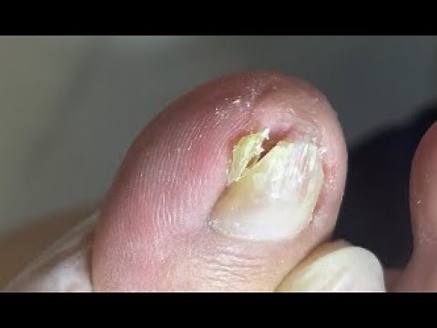 How to cut seriously curved nail