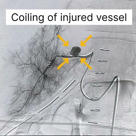 Embolisation for bleeding vessel in the Liver. #irad #embolization #embolisation #liver