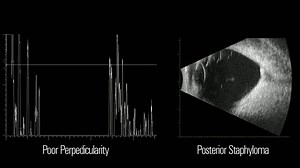Performing A-Scan Biometry with Quantel Ultrasound Systems - Eyetube