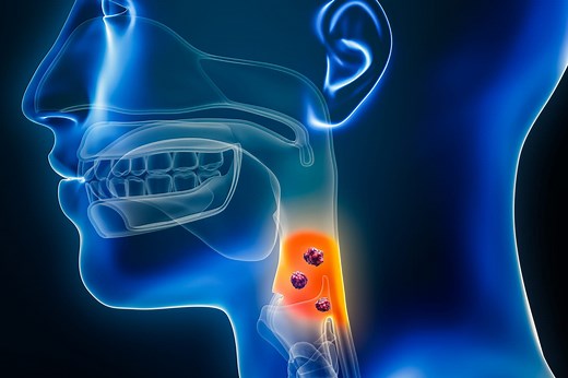 Cancer de la gorge : symptômes, cause, quelle espérance de vie ?