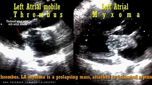 18K views · 139 reactions | Left Atrial Thrombus Vs Myxoma. | Medical Snippet | Facebook