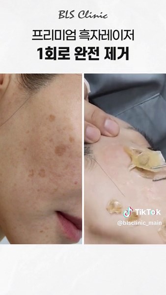 🔥지긋지긋한 #흑자 단 한번에 제거! 🔥 BLS클리닉 본점 프리미엄 색소레이저 '리팟' 전격도입! ✨리팟레이저 도입기념 40% 할인 이벤트✨ ✔️5mm 기준 55만원 – 33만원 ✔️10mm기준 110만원 - 66만원 #기미 #잡티 #검버섯 #색소침착 깊이도 원인도 다른 다양한 색소병변, 1:1 맞춤형 치료~🥰 📢더 많은 정보를 원하시면 유튜브에서 '닥터빅보스' 검색 유튜브에서 'BLS클리닉' 검색 BLS클리닉 본점이 특별한 이유 ! 👉🏻 오직 정품 기계. 정품 팁. 정량 사용 👉🏻 다양한 기계 보유로 개인별 맞춤시술 가능 👉🏻 숙련된 의료진. 다년간의 시술 경험 👉🏻 호텔식 침구. 프라이빗한 공간 👉🏻 담당 관리사 제도로 1:1 관리 👉🏻 다양한 통증경감 솔루션 서울도산대로67길13-5 (구)청담동93-12 BLS클리닉빌딩/압구정로데오역3번출구 📫 문의 및 예약 ✔인스타 - DM💌 ✔카카오톡ID - blsclinicap ✔플러스친구ID - BLS클리