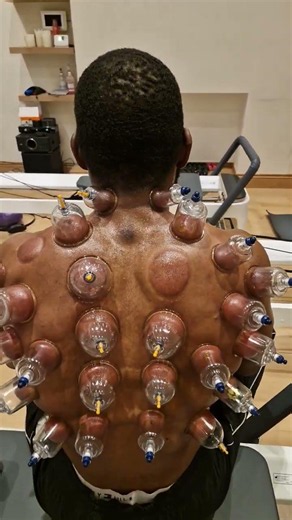 Mechanical cupping