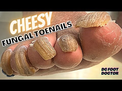 Cheesy Fungal Toenails: Trimming Long Toenails