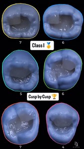 310 reactions · 66 shares | Class I Copmposite Cusp by Cusp 磊 Credit @malchenko__v #dentist #dentistry #dentalphotography | Dental Art | Facebook