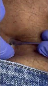 Removing large blackheads and pimples from face new 2026 #183