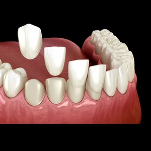 85 reactions · 17 comments | ❗Hey Delray Beach❗ Your dream smile is now within reach with Coastline Family Dental's Veneers Savings Program! Made from thin porcelain shells, dental veneers are custom-made to fit perfectly over your existing teeth. They are durable, stain-resistant and natural-looking, instantly transforming your smile for years to come. 朗 Schedule your appointment today with Dr. Dahms to get started! | Coastline Dental | Facebook