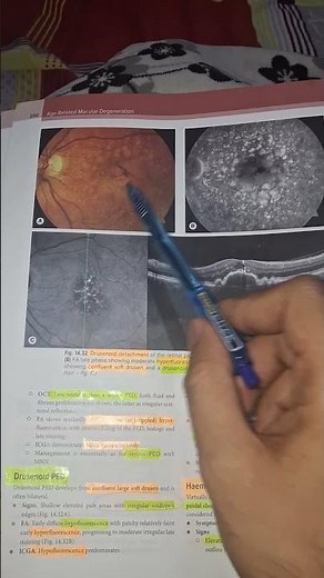 Drusenoid PED: Elevations of Dry AMD”