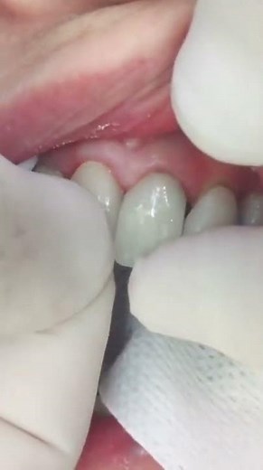 How Dentists Replace The Two Front Teeth With Crowns | View Mobile Dental