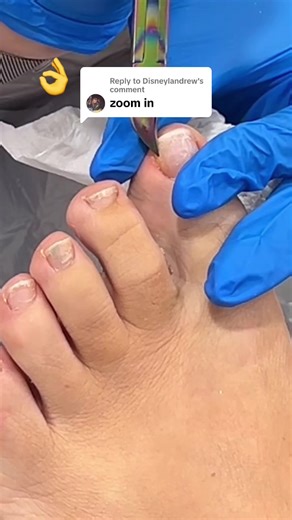 Understanding Ingrown Toenails: Causes and Solutions
