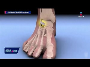 Síndrome Ehlers Danlos: descubre sus síntomas y características | Visita de Doctor