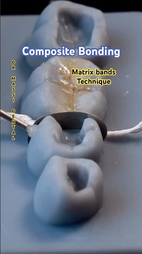 Composite Bonding matrix band Technique