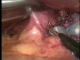 Adjustable gastric band removal - laparoscopic method • Video • MEDtube.net