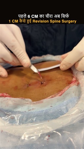 6 CM का चीरा हुआ Only 1 CM! Revision Spine Surgery में Endoscopy Spine Surgery का कमाल! #shoersfeed