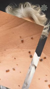 Comment éliminer les acrochordons simplement avec cette recette #acrochordon #bouton #soinvisagenaturel #recettenaturelle | HealthyVibe