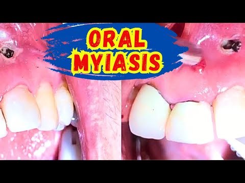 Oral Myiasis EXPOSED! Don't Ignore These Hidden Dangers
