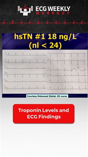 ECGWeekly, LLC on Instagram: "ECGWeekly Case of the Week: Subtle reciprocal changes—especially T-wave inversion or ST depression in aVL—may precede ST elevation in early inferior STEMI. When symptoms persist, repeat the ECG. Early recognition matters."