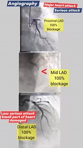 260K views · 546 reactions | LAD coronary angiography showing occlusion , | Cardiophilia | Facebook