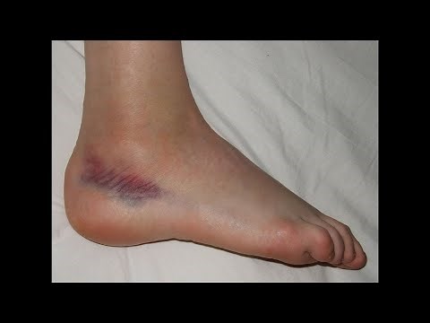 Sprained Foot Tendon or Ligament - Home Treatment Guide!