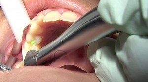 Class II Cavity Preparation