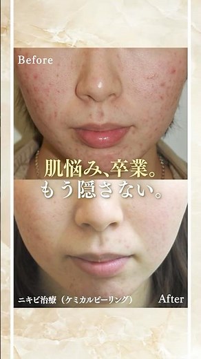 ◆施術内容◆症例 1 ニキビ治療（ケミカルピーリング） 22歳女性標準的な治療費用 7,700～198,000 円 （税込）◆リスクと合併症◆色素沈着、赤み、腫れなど