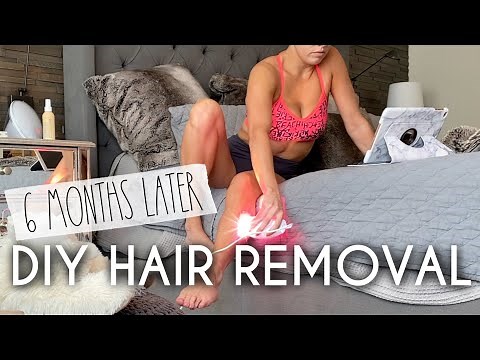 IPL Hair Removal at home | 6 Months Later