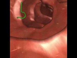 Upper gastrointestinal tract endoscopy