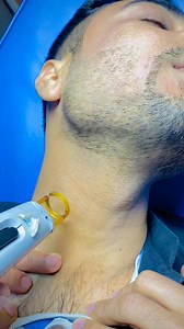 69K views · 593 reactions | Face Hair removal Lazer Candela | Majid Cosmetics Centre | Facebook