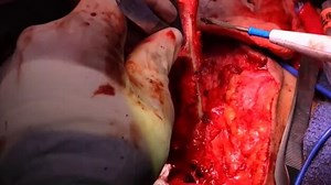 Male-to-female transgender surgery: a basic tutorial