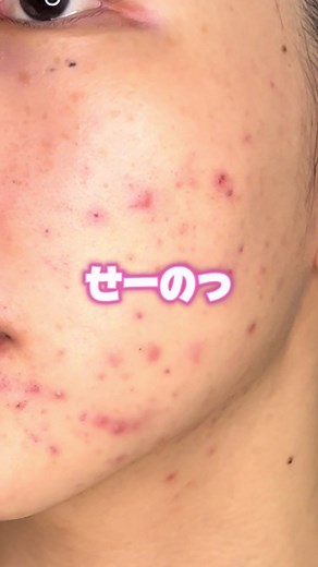 キテンハイドロキノンクリームでニキビ跡改善