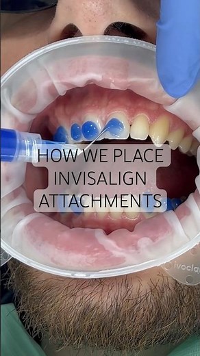 How we place Invisalign attachments or ‘buttons’… 🙌 #invisalign #newsmile #viral