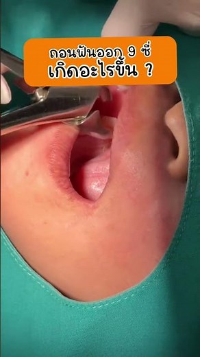 #9 tooth extraction, what happened? #Dr.Am from #TheDent has the answer for you.