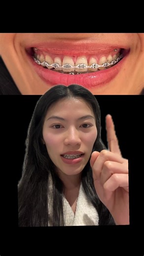 Amazing Braces Transformation: From Gummysmile to Beautiful Smile!