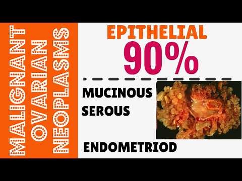 Topic 55: Ovarian Neoplasms