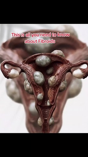 Fibroids are non cancerous (benign) tumors of the uterus They are the most common pelvic tumors. Risk factors Family history age infertility #fibroids #womenoftiktok #medical #daktarimuriuki #healthylifestyle