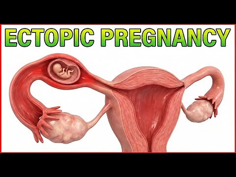 Ectopic Pregnancy: Classification, Pathogenesis, Clinical features, Diagnosis & Treatment
