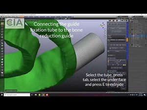 Stackable guide know How: Part 2-Designing the bone reduction guide