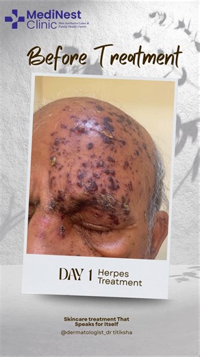 Herpes treatment before and after results #skincare #herpesawareness #herpestrearment #skindisorders