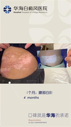 Four Months of Living With Vitiligo | Facial, Waist and Back Skin Changes #vitíligo