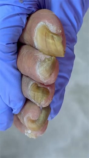 toenail removed successfully #nails #toenail #toenailremoval #ingrowntoenail #ingrownnail #toenailfungus #pedicure #onychomycosis Disclaimer: This video contains clips collected from various sources. Full credit goes to the original Chinese creators. This content is used for educational and monetization purposes only. All rights belong to their respective owners. | Quranic Life